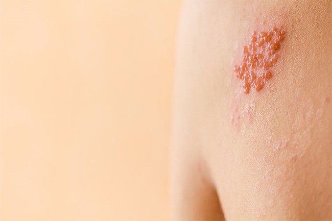 Phân biệt vết thương do kiến ba khoang với viêm da do zona để tránh dùng sai thuốc khiến bệnh càng khó chữa - Ảnh 3.