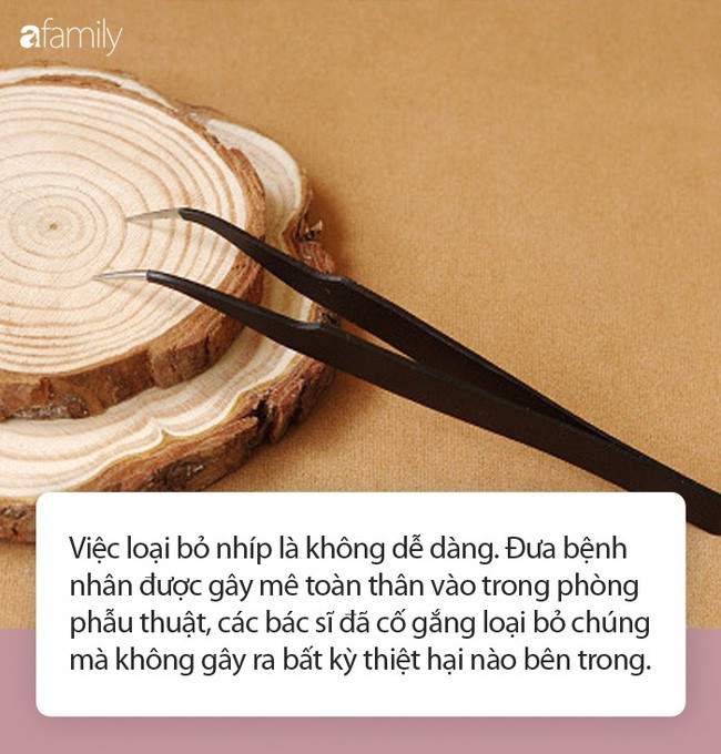 Kinh hãi nam thanh niên nhét cặp nhíp vào niệu đạo 4 năm trời mà không hay biết - Ảnh 1.