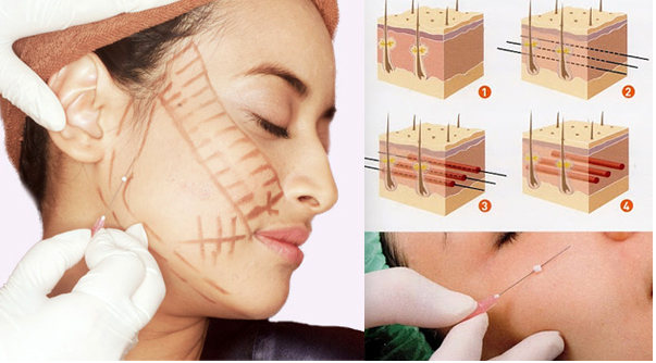 Trong các phương pháp căng da mặt, căng da mặt bằng chỉ, dù nhẹ nhàng nhất nhưng cũng có rủi ro biến chứng đi kèm! - Ảnh 3.