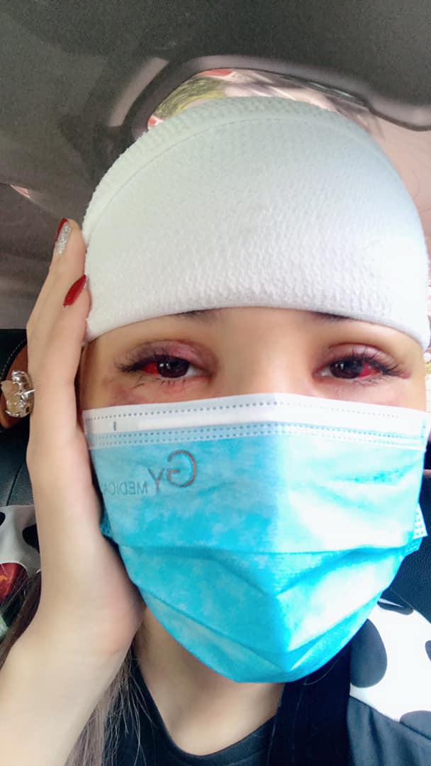 Siêu mẫu Khả Trang bị tai nạn tụ máu đầu và mắt, phải mất 2 tháng mới hoàn toàn bình phục - Ảnh 1.