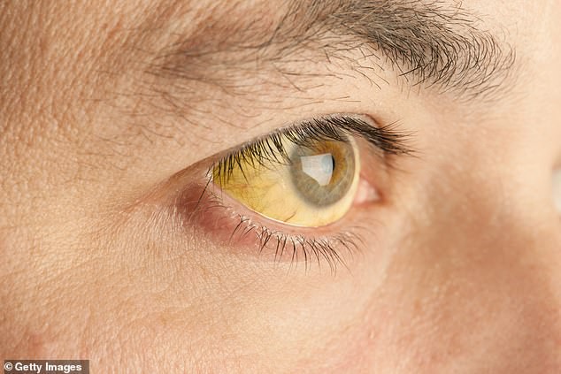 Chuyên gia hé lộ 7 dấu hiệu lạ trên mắt cảnh báo những vấn đề sức khỏe không thể xem thường - Ảnh 4.