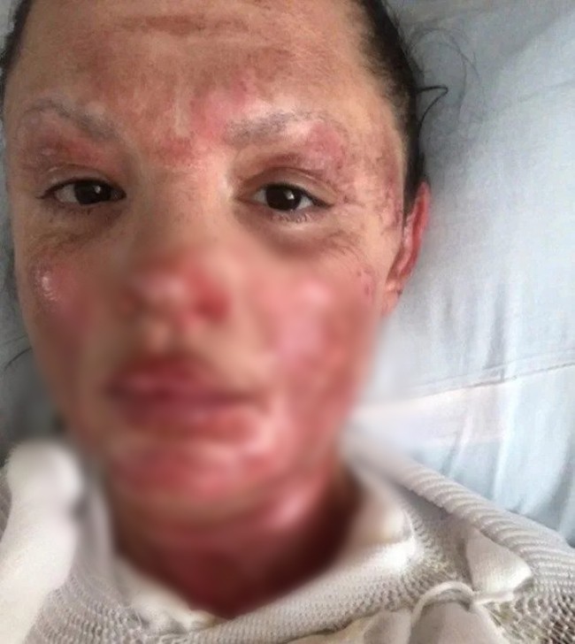 Mở nắp l&ograve; BBQ để chuẩn bị nướng thịt, người phụ nữ bị bỏng khắp mặt v&agrave; người do ngọn lửa ch&aacute;y &acirc;m ỉ l&acirc;u ng&agrave;y - Ảnh 1.