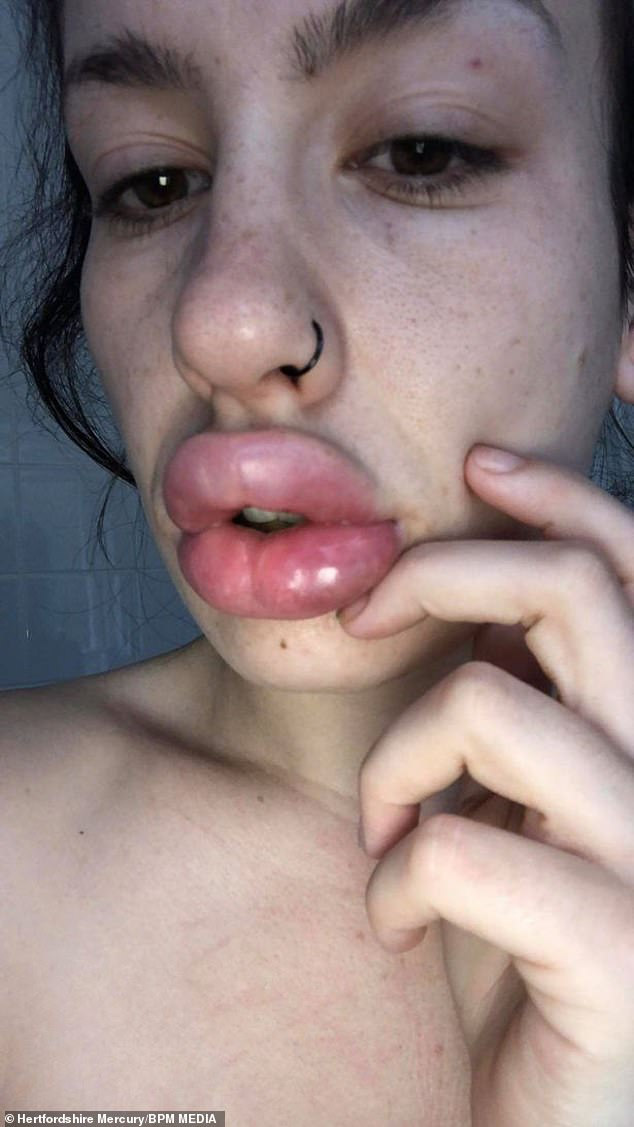 Thích môi tều như Kylie Jenner, người phụ nữ trẻ đi tiêm chất làm đầy giá rẻ và hậu quả khiến cô vô cùng hối hận - Ảnh 2.