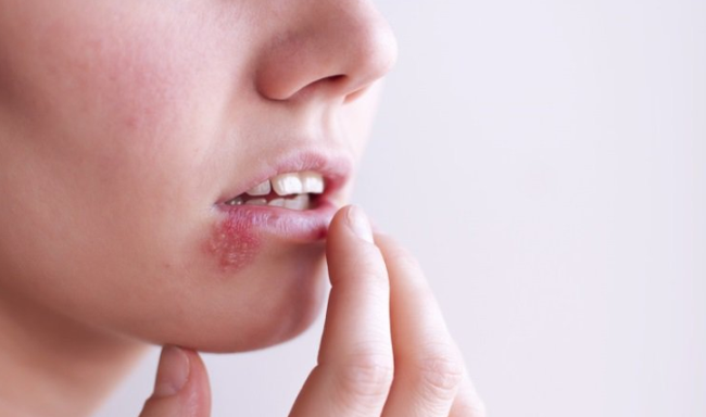 Những nhầm tưởng về mụn rộp sinh dục herpes mà không ít phụ nữ mắc phải - Ảnh 1.