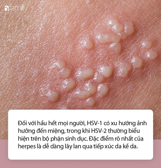 Những nhầm tưởng về mụn rộp sinh dục herpes mà không ít phụ nữ mắc phải - Ảnh 2.