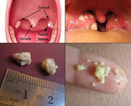 Bị người yêu chia tay vì mùi hôi miệng, cô gái trẻ uất ức đi khám mới biết mình có sỏi amidan - Ảnh 4.