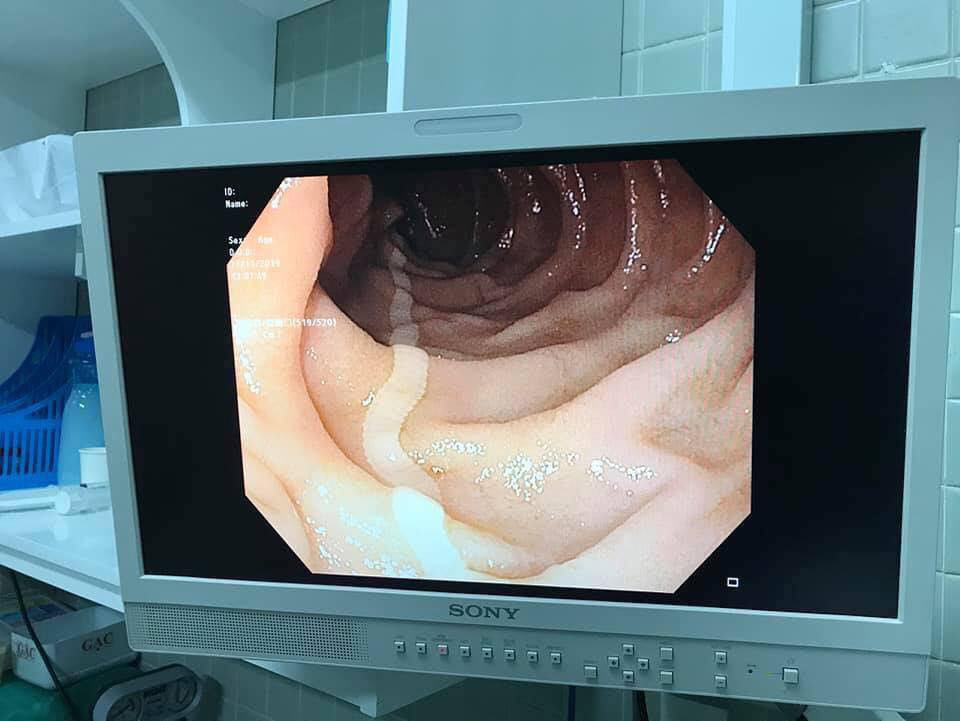 Clip: Kinh hãi cảnh bác sĩ kéo sán dây bò dài cả mét từ miệng bệnh nhân, cảnh báo khi ăn thực phẩm sống không đảm bảo - Ảnh 3. Clip: Kinh hãi cảnh bác sĩ kéo sán dây bò dài cả mét từ miệng bệnh nhân, cảnh báo khi ăn thực phẩm sống không đảm bảo - Ảnh 3.