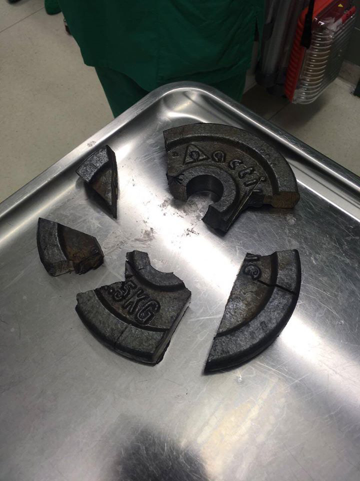 Gym naughty: Put it in the barbell and get stuck, rescue takes 3 hours to remove - Photo 1. Gym naughty: Put it in the barbell and get stuck, rescue takes 3 hours to remove - Photo 1.