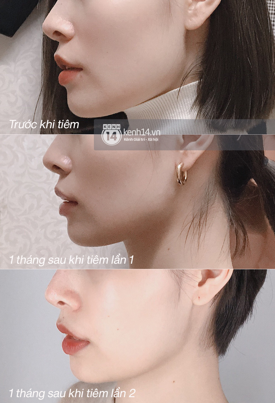 Tôi đi tiêm botox gọn hàm: 1 lần botox Âu Mỹ, 1 lần botox Hàn, mặt chỉ thay đổi sương sương chứ không lột xác được như người ta - Ảnh 1. Tôi đi tiêm botox gọn hàm: 1 lần botox Âu Mỹ, 1 lần botox Hàn, mặt chỉ thay đổi sương sương chứ không lột xác được như người ta - Ảnh 1.