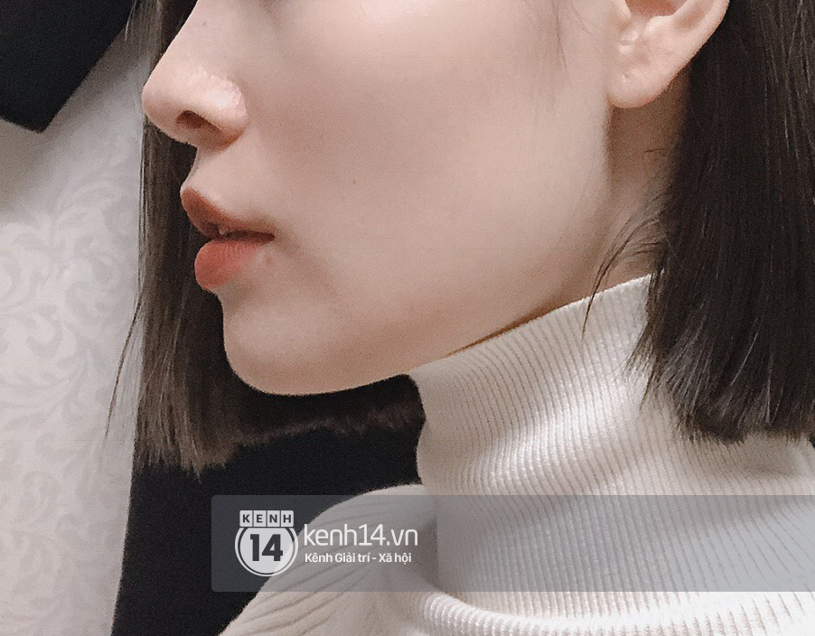 Tôi đi tiêm botox gọn hàm: 1 lần botox Âu Mỹ, 1 lần botox Hàn, mặt chỉ thay đổi sương sương chứ không lột xác được như người ta - Ảnh 2. Tôi đi tiêm botox gọn hàm: 1 lần botox Âu Mỹ, 1 lần botox Hàn, mặt chỉ thay đổi sương sương chứ không lột xác được như người ta - Ảnh 2.