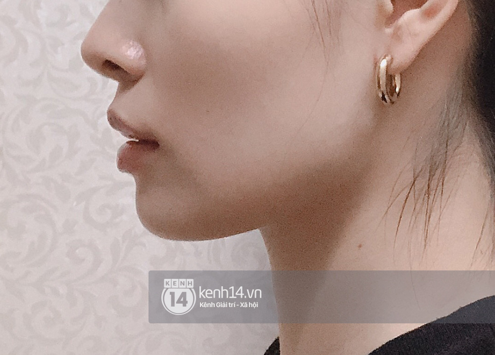 Tôi đi tiêm botox gọn hàm: 1 lần botox Âu Mỹ, 1 lần botox Hàn, mặt chỉ thay đổi sương sương chứ không lột xác được như người ta - Ảnh 4. Tôi đi tiêm botox gọn hàm: 1 lần botox Âu Mỹ, 1 lần botox Hàn, mặt chỉ thay đổi sương sương chứ không lột xác được như người ta - Ảnh 4.