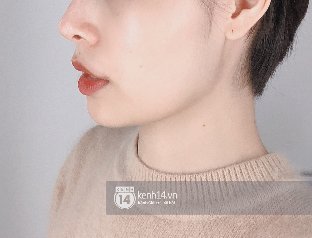 Tôi đi tiêm botox gọn hàm: 1 lần botox Âu Mỹ, 1 lần botox Hàn, mặt chỉ thay đổi sương sương chứ không lột xác được như người ta - Ảnh 7. Tôi đi tiêm botox gọn hàm: 1 lần botox Âu Mỹ, 1 lần botox Hàn, mặt chỉ thay đổi sương sương chứ không lột xác được như người ta - Ảnh 7.