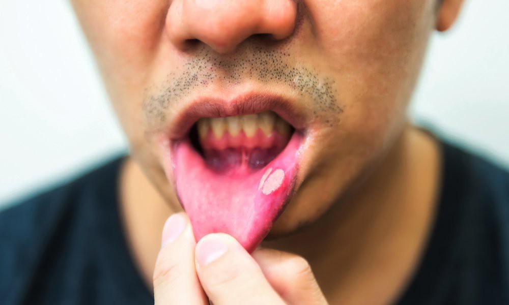 Đây là những triệu chứng cảnh báo ung thư sớm mà con trai không nên chủ quan bỏ qua - Ảnh 5. Đây là những triệu chứng cảnh báo ung thư sớm mà con trai không nên chủ quan bỏ qua