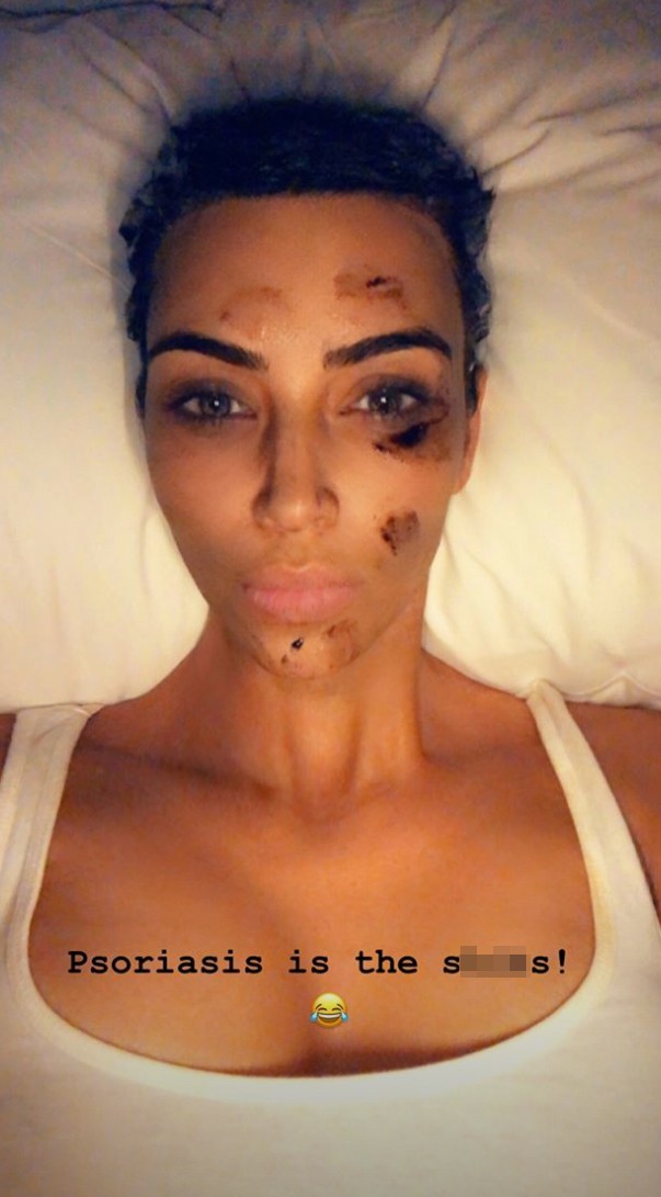 Kim Kardashian gây sửng sốt với đôi chân loang lổ và gương mặt bôi đầy thuốc vì bị bệnh vảy nến - Ảnh 1.