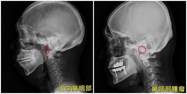 Người đàn ông bị nghẹt mũi, đêm ngủ ngáy, đi khám xong thì sốc bởi phát hiện bệnh nguy hiểm - Ảnh 1.