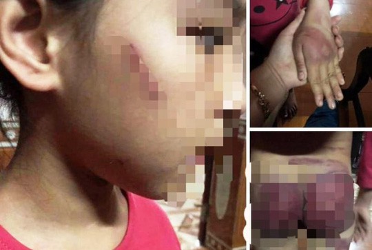 Mẹ rớt nước mắt thấy con g&aacute;i 8 tuổi bị bố bạo h&agrave;nh th&acirc;m t&iacute;m khắp người - Ảnh 3.
