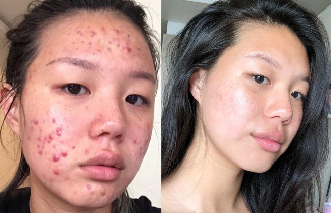 Dù bị mụn hay không, bạn cũng sẽ học được nhiều tips skincare từ cô nàng lột xác làn da đầy tỳ vết thành trơn láng, mịn đẹp này - Ảnh 1.