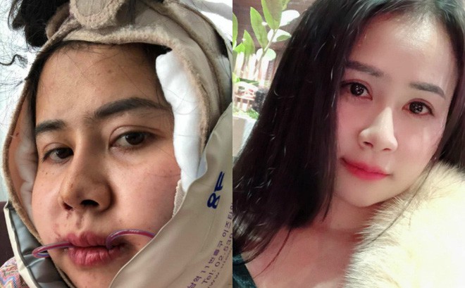 Bị chồng bỏ v&igrave; xấu, bị c&ocirc; g&aacute;i trẻ đẹp n&oacute;i 1 c&acirc;u cay nghiệt, người phụ nữ chấp nhận đau đớn để thay đổi - Ảnh 1.