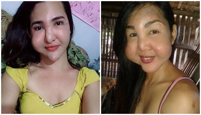Đôi bạn thân gây sốc vì gương mặt biến dạng sau khi phẫu thuật thẩm mỹ chui - Ảnh 3.