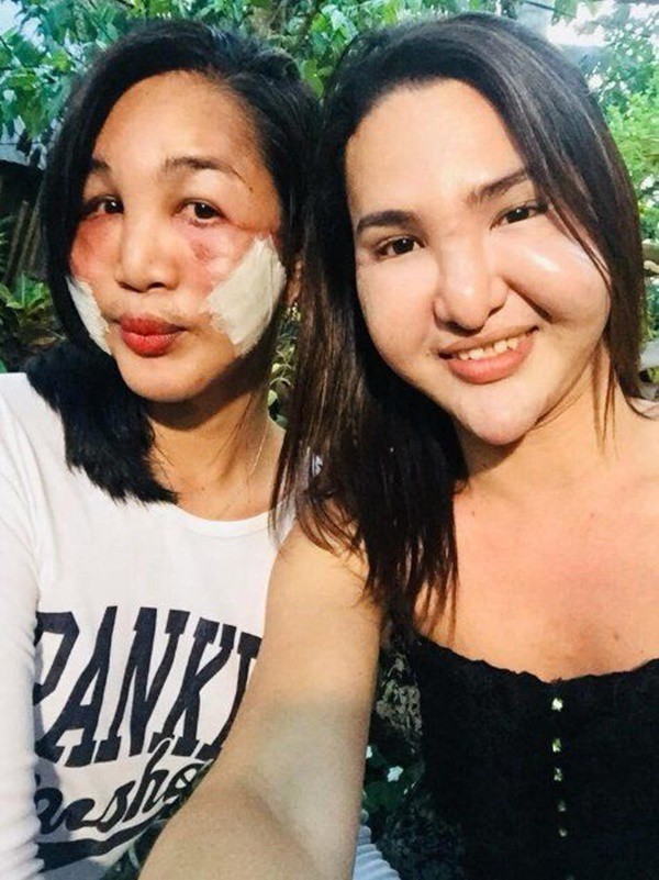 Đ&ocirc;i bạn th&acirc;n c&ugrave;ng tiến: Rủ nhau phẫu thuật thẩm mỹ chui, đến l&uacute;c biến dạng cả khu&ocirc;n mặt cũng c&oacute; nhau - Ảnh 1.