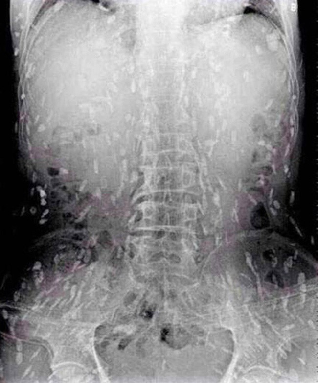 Một số hình ảnh bệnh nhân bị nhiễm Ấu trùng giun đũa chó Toxocara bệnh sán  chó