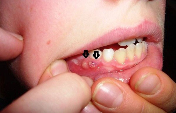 Răng có lỗ sâu to mà để lâu sẽ dẫn đến những biến chứng gì? - Ảnh 4.