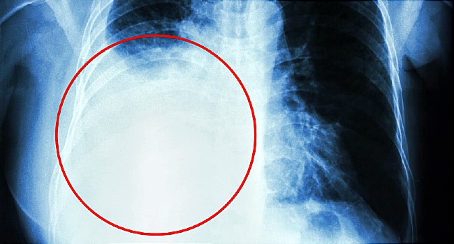 Những triệu chứng cho thấy ung thư vú di căn sang phổi và các cách để phòng tránh - Ảnh 4.