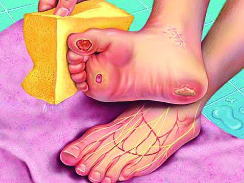Cẩn thận với 6 dấu hiệu khác thường ở bàn chân đang ngầm cảnh báo bệnh - Ảnh 6.
