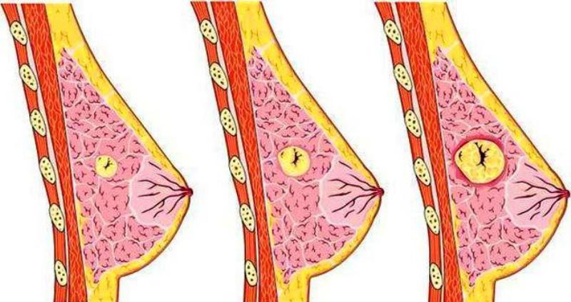 Có tới 4 loại u vú lành tính mà nữ giới hay gặp nhưng nên chữa trị từ sớm để ngăn ngừa nguy cơ phát triển thành ung thư vú - Ảnh 1.