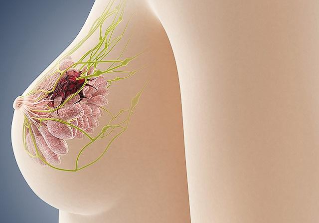 Có tới 4 loại u vú lành tính mà nữ giới hay gặp nhưng nên chữa trị từ sớm để ngăn ngừa nguy cơ phát triển thành ung thư vú - Ảnh 2.
