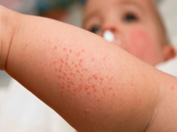 Chuyên gia cảnh báo: Cẩn trọng bệnh sốt xuất huyết đang có xu hướng tăng mạnh - Ảnh 2.