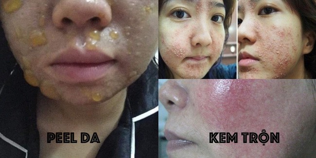 Không chỉ kem trộn, xu hướng tự peel da tại nhà cũng có thể khiến bạn hóa quỷ sau 1 lần sử dụng - Ảnh  6.