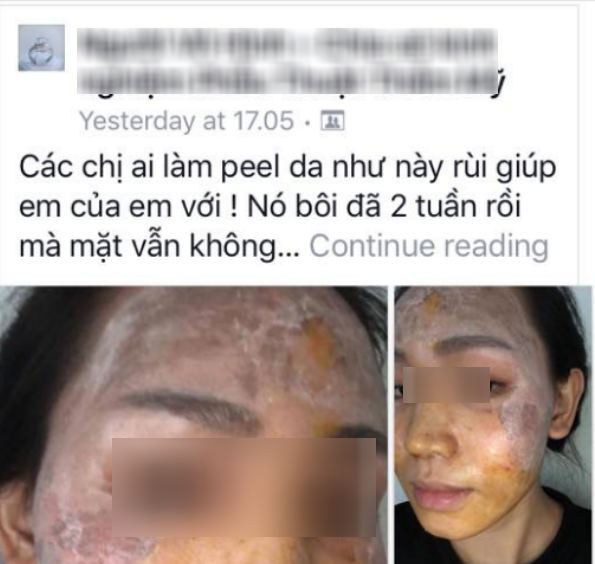 Không chỉ kem trộn, xu hướng tự peel da tại nhà cũng có thể khiến bạn hóa quỷ sau 1 lần sử dụng - Ảnh 4.