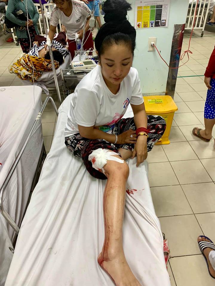 Diá»
n viên hà i Thúy Nga gặp tai nạn chảy Äầy máu chân, phải nháºp viá»n khâu 10 mÅ©i - Ảnh 1.