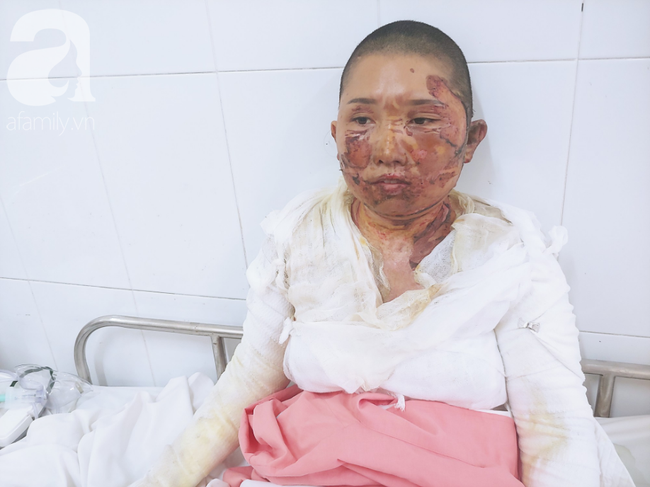 Bố d&ugrave;ng xăng đốt khiến mẹ biến dạng khu&ocirc;n mặt, con g&aacute;i 8 tuổi kh&oacute;c ngất: Mẹ c&oacute; xấu nhưng con vẫn nhận ra mẹ m&agrave; - Ảnh 3.