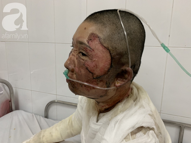 Bố d&ugrave;ng xăng đốt khiến mẹ biến dạng khu&ocirc;n mặt, con g&aacute;i 8 tuổi kh&oacute;c ngất: Mẹ c&oacute; xấu nhưng con vẫn nhận ra mẹ m&agrave; - Ảnh 6.
