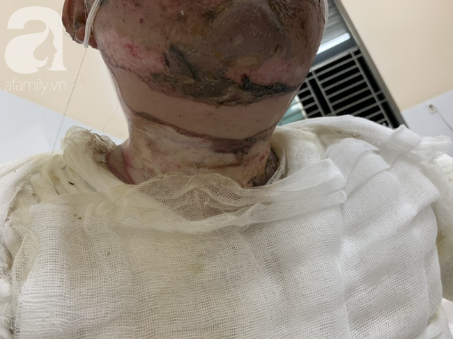 Bố d&ugrave;ng xăng đốt khiến mẹ biến dạng khu&ocirc;n mặt, con g&aacute;i 8 tuổi kh&oacute;c ngất: Mẹ c&oacute; xấu nhưng con vẫn nhận ra mẹ m&agrave; - Ảnh 8.