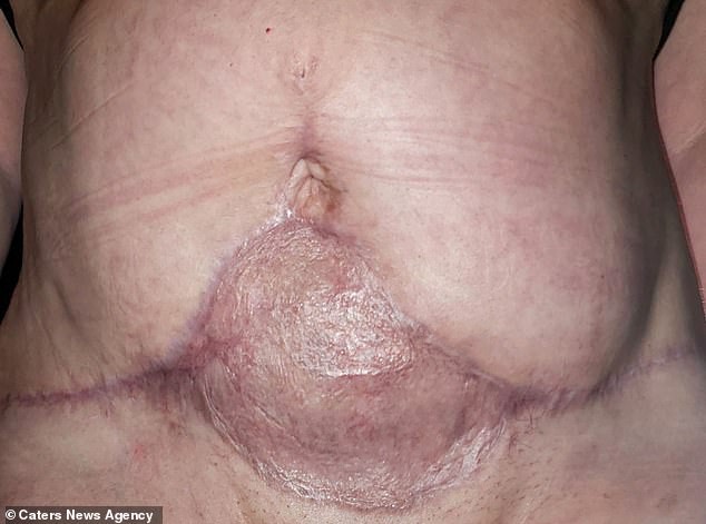 Bỏ ra gần 100 triệu để đi hút mỡ, người phụ nữ gặp biến chứng khiến da bụng bị thối đen - Ảnh 4.