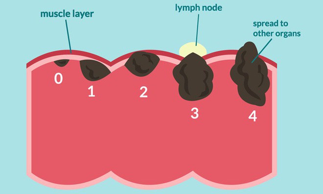 Bí ẩn: Tỷ lệ ung thư đại trực tràng của thế hệ 9x đã tăng gấp 2-4 lần thế hệ ông bà - Ảnh 2.