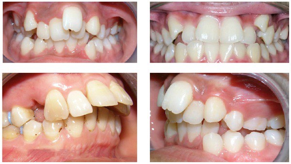 Thêm một ca niềng răng hiệu quả đến kinh ngạc, khiến dân tình càng tin đây là phương pháp bậc thầy trong ngành thẩm mỹ - Ảnh 5.