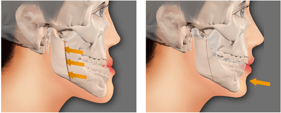 Bạn có thuộc một trong những trường hợp bắt buộc phải niềng răng sau đây hay không? - Ảnh 6.