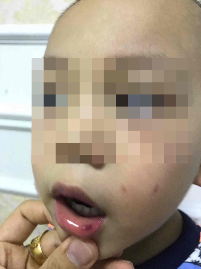 Cô giáo ở Hà Nội tát bé hơn 2 tuổi sấp mặt, tụ máu môi đang bị hoảng loạn và có suy nghĩ quẩn - Ảnh 2.