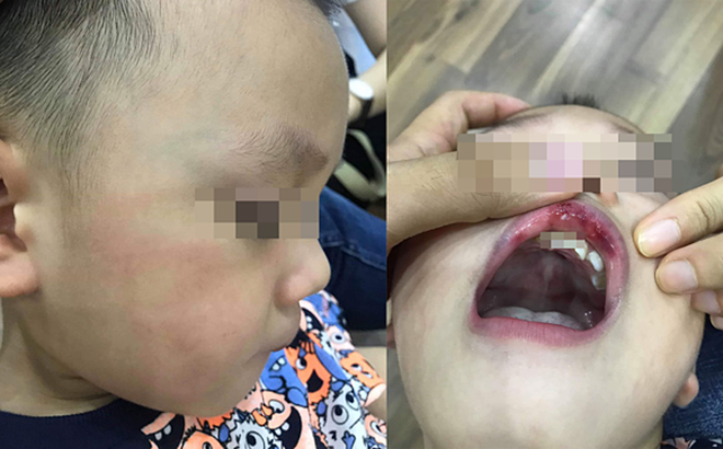 Cô giáo ở Hà Nội tát bé hơn 2 tuổi sấp mặt, tụ máu môi đang bị hoảng loạn và có suy nghĩ quẩn - Ảnh 1.