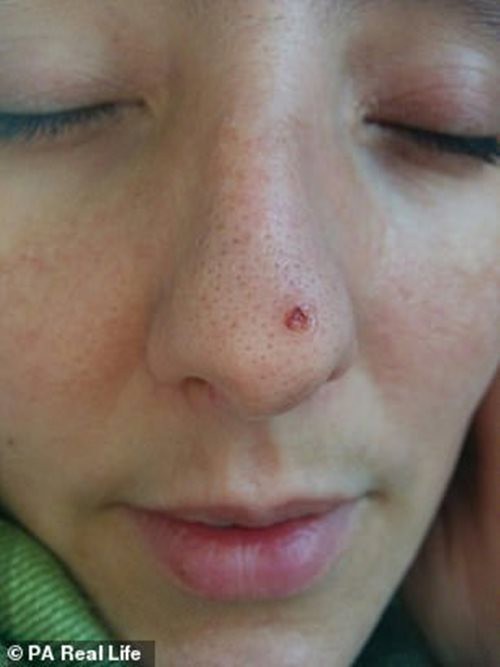 Nghiện làm đẹp da, người phụ nữ bị cắt mất một đoạn mũi - Ảnh 1.