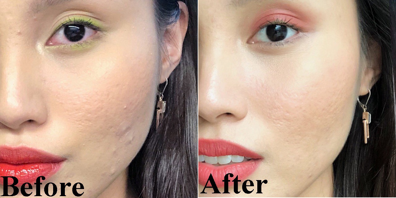 Mặt mụn lấm tấm nhưng nhờ tối giản hóa chu trình skincare mà làn da của cô nàng này đã thay đổi hẳn sau 2 tuần - Ảnh 1.