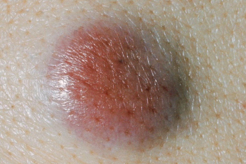 Bác sĩ da liễu Mỹ chỉ ra cách phân biệt 5 loại ung thư da phổ biến để kịp thời phòng tránh từ sớm - Ảnh 5.