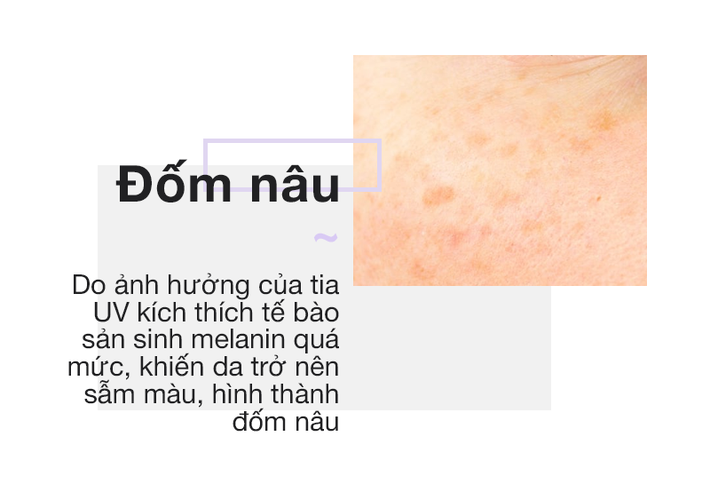 Chỉ cần nhìn vào 2 bên gò má sẽ biết ngay bạn đang bị nám hay đốm nâu - Ảnh 3.