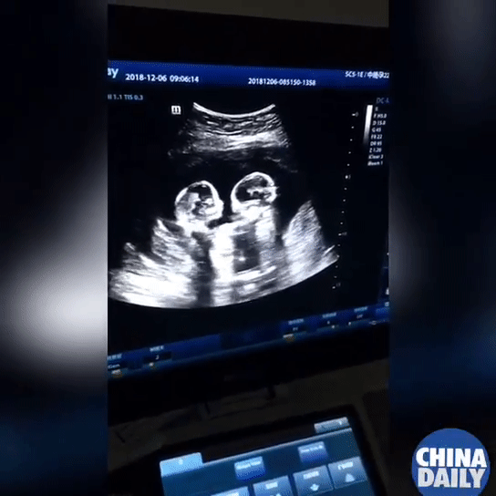 Chụp ảnh siêu âm mà giơ tay chào đủ kiểu, em bé từ trong bụng mẹ đã được dự đoán tương lai sau này vô cùng xán lạn - Ảnh 3.