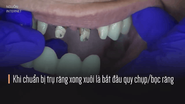 Cái giá của sự đẹp: Cận cảnh quy trình bọc răng sứ khiến người xem cũng phải thót tim - Ảnh 9.