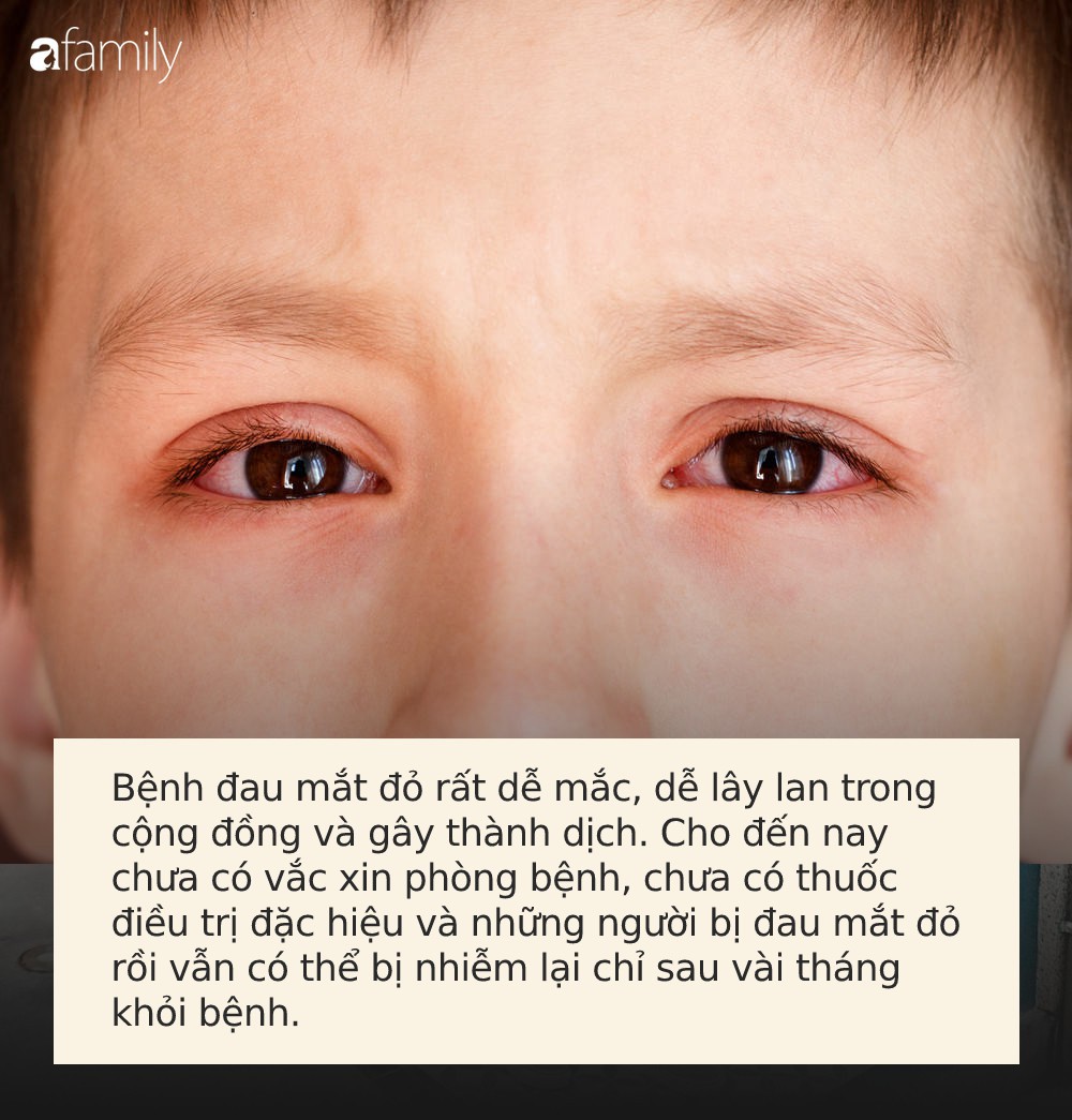 Đau mắt đỏ có thể bùng phát trong mùa hè, muốn phòng bệnh hãy làm đủ 5 việc này mỗi ngày - Ảnh 1. Đau mắt đỏ có thể bùng phát trong mùa hè, muốn phòng bệnh hãy làm đủ 5 việc này mỗi ngày - Ảnh 1.